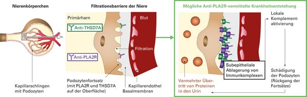 PLA2R und THSD7A werden auf der Oberfläche der Podozyten exprimiert