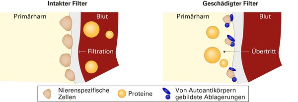 Gestörte Filterfunktion der Niere durch antikörpervermittelte Ablagerungen