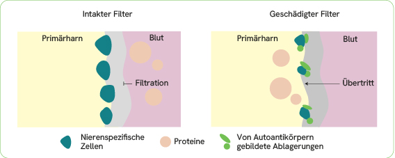 Gestörte Filterfunktion der Niere durch antikörpervermittelte Ablagerungen
